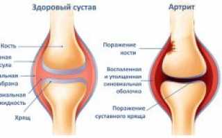 Почему после химиотерапии возможны боли в ногах и как с ними справиться