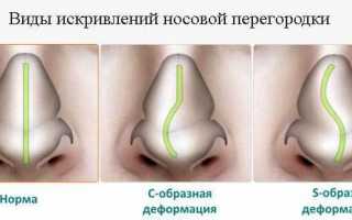 Исправление носовой перегородки: лазером и без операции: фото до и после