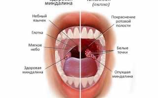 Чем вызван симптом рыхлого горла у детей и как избежать вредных последствий