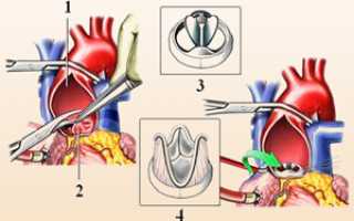 Наиболее эффективные методы протезирования аортального клапана