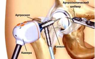 Операция при артрозе тазобедренного сустава