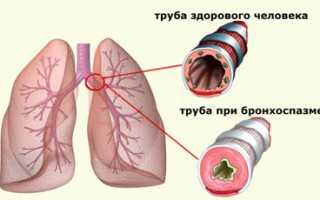 Кашель и одышка: о чём свидетельствует совокупность симптомов и как с ними справиться