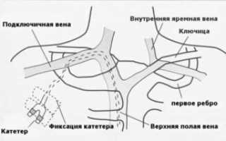 Венозный катетер — что из себя представляет