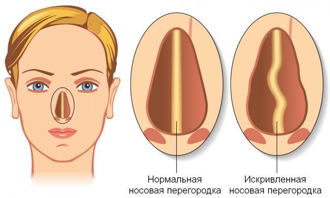 Normalnaya-i-krivaya-peregorodka.jpg
