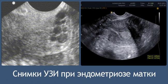 снимки УЗИ