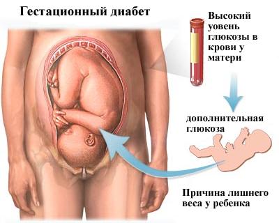 Гестационный-диабет.jpg