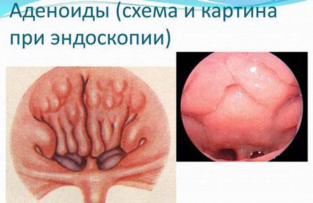 Хронический аденоидит