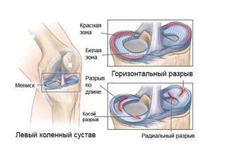 Схематичное-изображение-разрыва-мениска-320x214.jpg