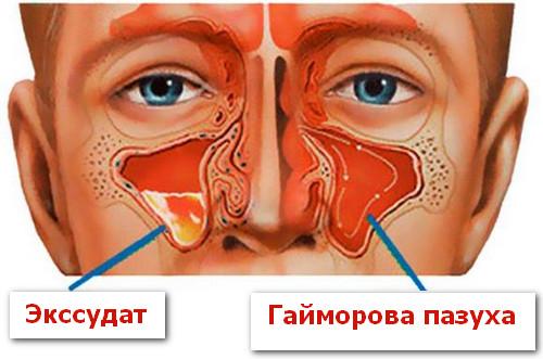 Экссудат в гайморовой пазухе