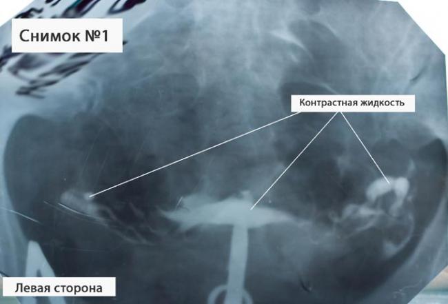 контрастная жидкость