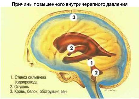 prichiny-povyshennogo-vnutricherepnogo-davleniya.jpg
