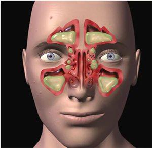simptomy-gnoinogo-gaimorita.jpg