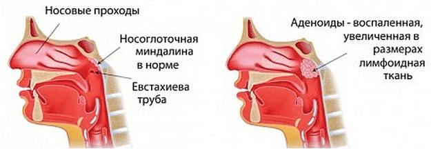 Kratko-i-ponyatno-ob-adenoidah-v-nosu-v-anatomicheskom-aspekte-norma-patologiya.png