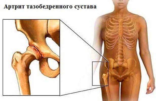 Artrit-simptomy-i-lechenie-tazobedrennogo-sustava.jpg
