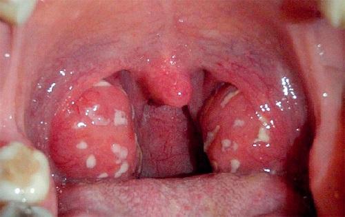 Follikulyarnaya-angina-chto-eto.jpg