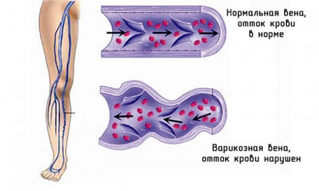 narushenie-venoznogo-ottoka-660x395.jpg
