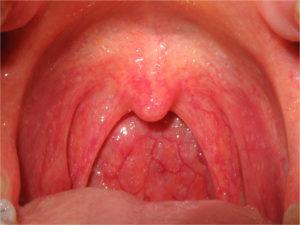 Pharyngitis-300x225.jpg