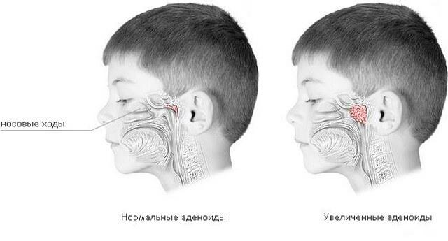 adenoids.jpg