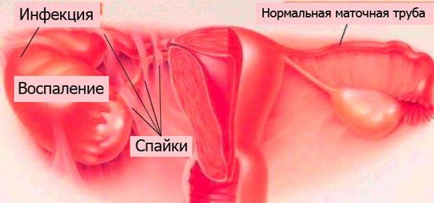 причины трубного бесплодия