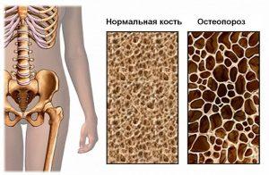 osteoporoz2-300x196.jpg