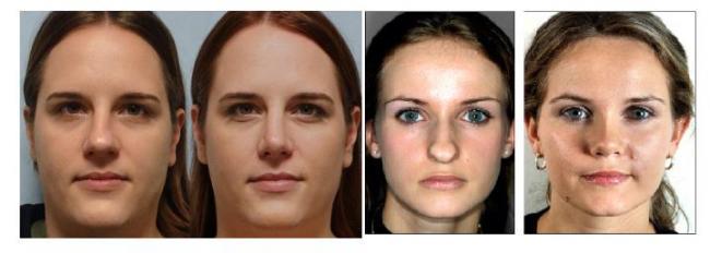 rinoplastika-do-i-posle.jpg