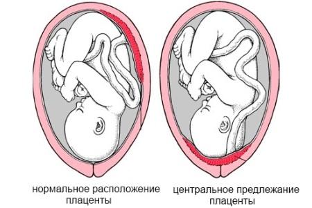 tsentralnoe-predlezhanie-platsenty.jpg