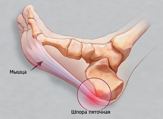 osteofity.jpg