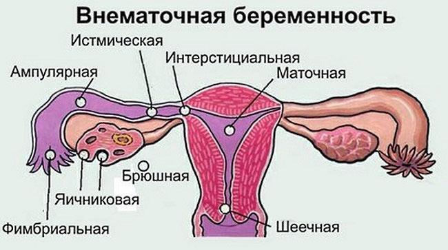 внематочная беременность