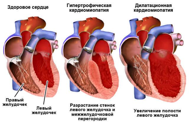 kardiomiopatiya.jpg
