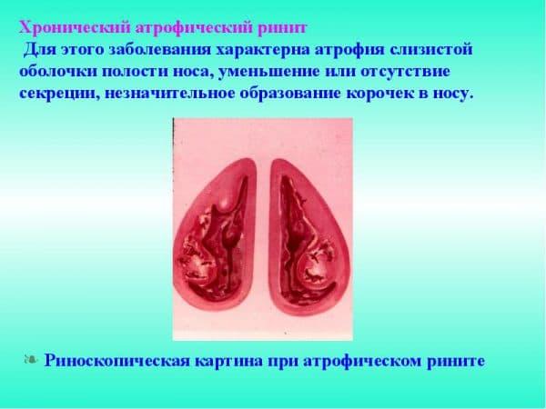 %D0%A5%D1%80%D0%BE%D0%BD%D0%B8%D1%87%D0%B5%D1%81%D0%BA%D0%B8%D0%B9-%D0%B0%D1%82%D1%80%D0%BE%D1%84%D0%B8%D1%87%D0%B5%D1%81%D0%BA%D0%B8%D0%B9-%D1%80%D0%B8%D0%BD%D0%B8%D1%82-600x450.jpg