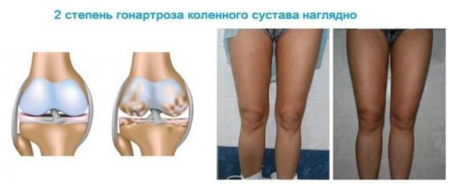 Deformaciya-kolennogo-sustava-lechenie.jpg