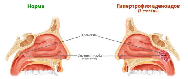 adenoidy.jpg