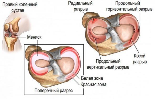 travma-meniska-660x420.jpg