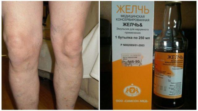 Medicinskaya-zhelch-pri-artroze-kolennogo-sustava-1-e1532340020799.jpg