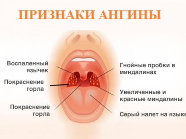 doktor-komarovskij-ob-angine-4-600x450.png