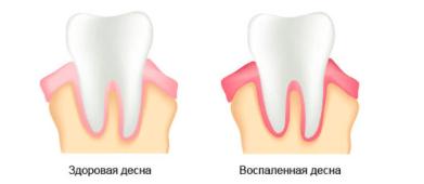 chto-mozhet-vyzyvat-bol-v-grudnoy-kletke-pri-glotanii-4.png