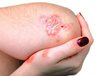 dieta-psoriaticheskij-artrit-1.jpg