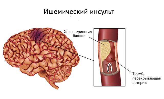 ishemicheskij-insult.jpg