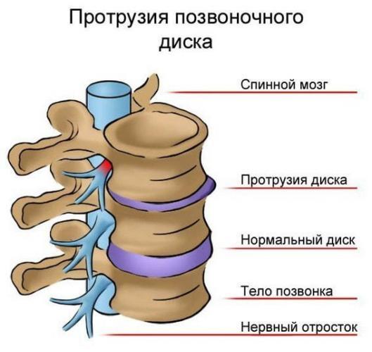 bol-v-pojasnice-otdaet-v-levuju-nogu.jpg
