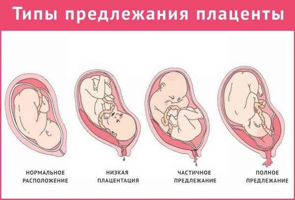 предлежание плаценты
