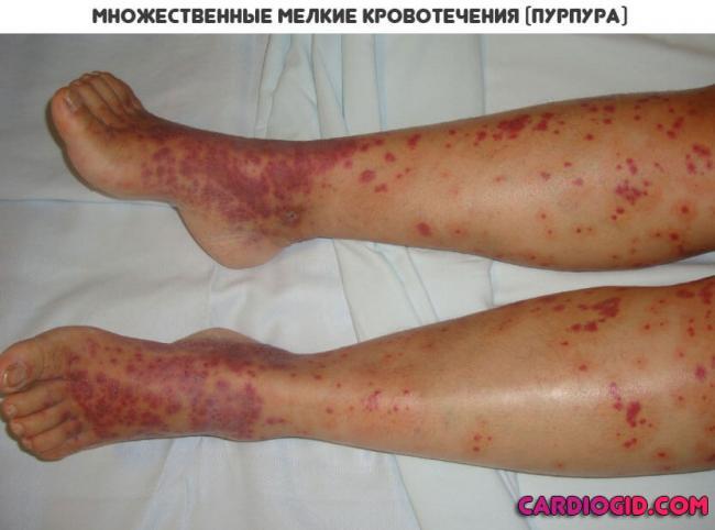 trombotsitopenicheskaya-purpura.jpg