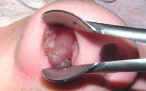 polipy-nosa1.jpg
