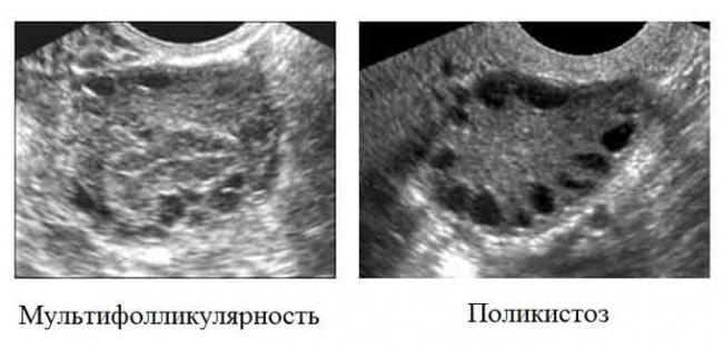 мультифолликулярность и поликистоз