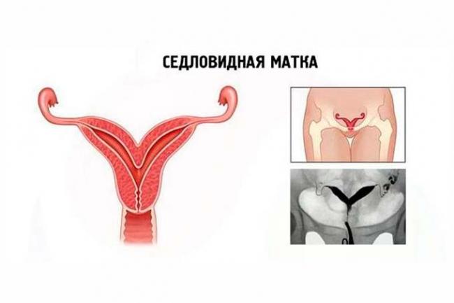 схема седовидной матки