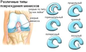 Различные-типо-повреждения-мениска-300x184.png