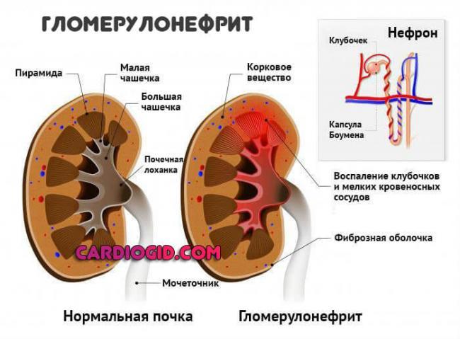 Glomerulonefrit.jpg