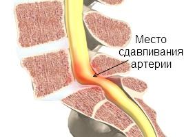 pozvon-arteria.jpg