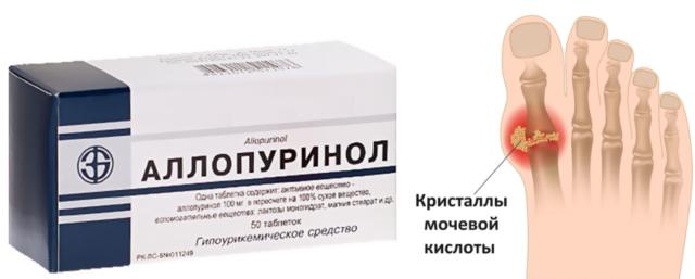 Lechenie-podagricheskogo-artrita-1-e1526887964952.png