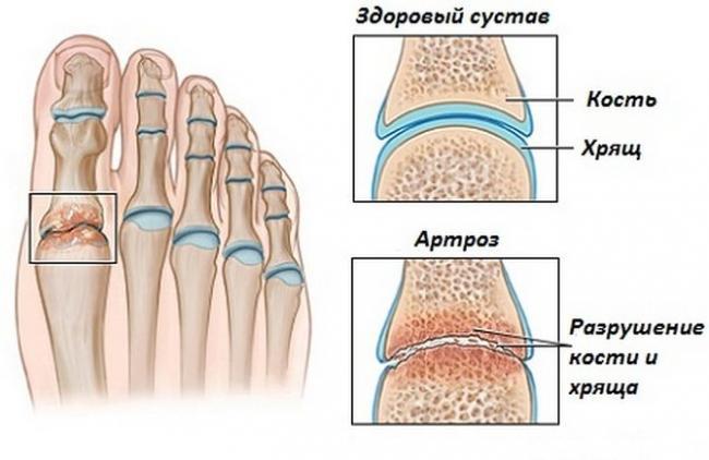 artroz-stopy.jpg