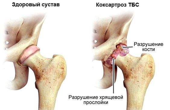 Koksartroz-2.jpg